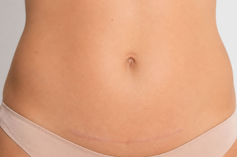 Abdominoplasty consultation