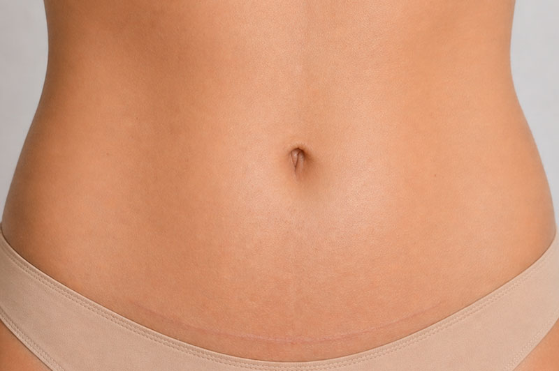 Fleur de lis abdominoplasty consultation
