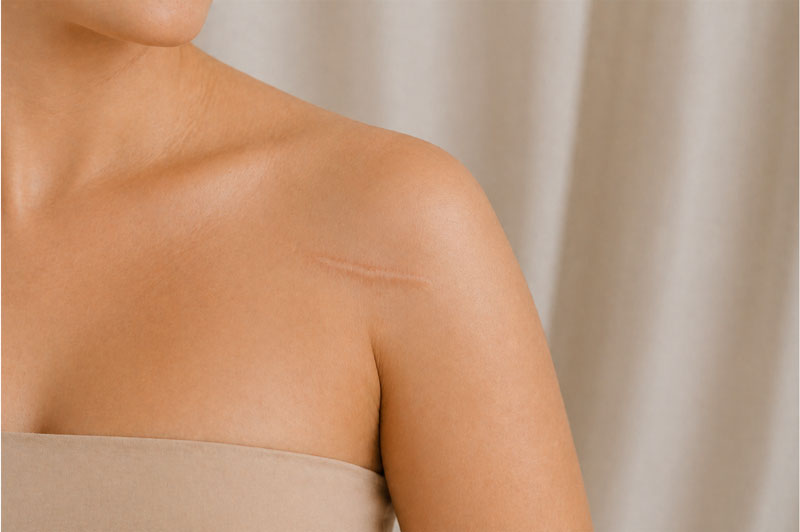 Surgical scar revision consultation