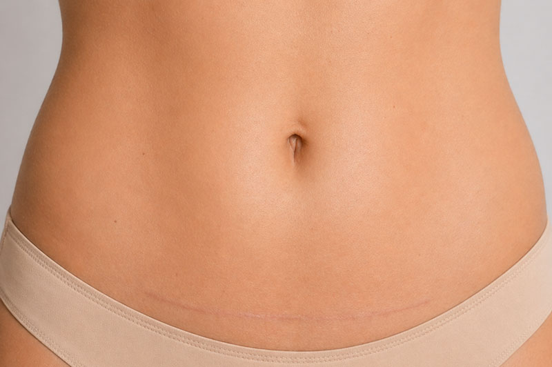 Mini abdominoplasty consultation